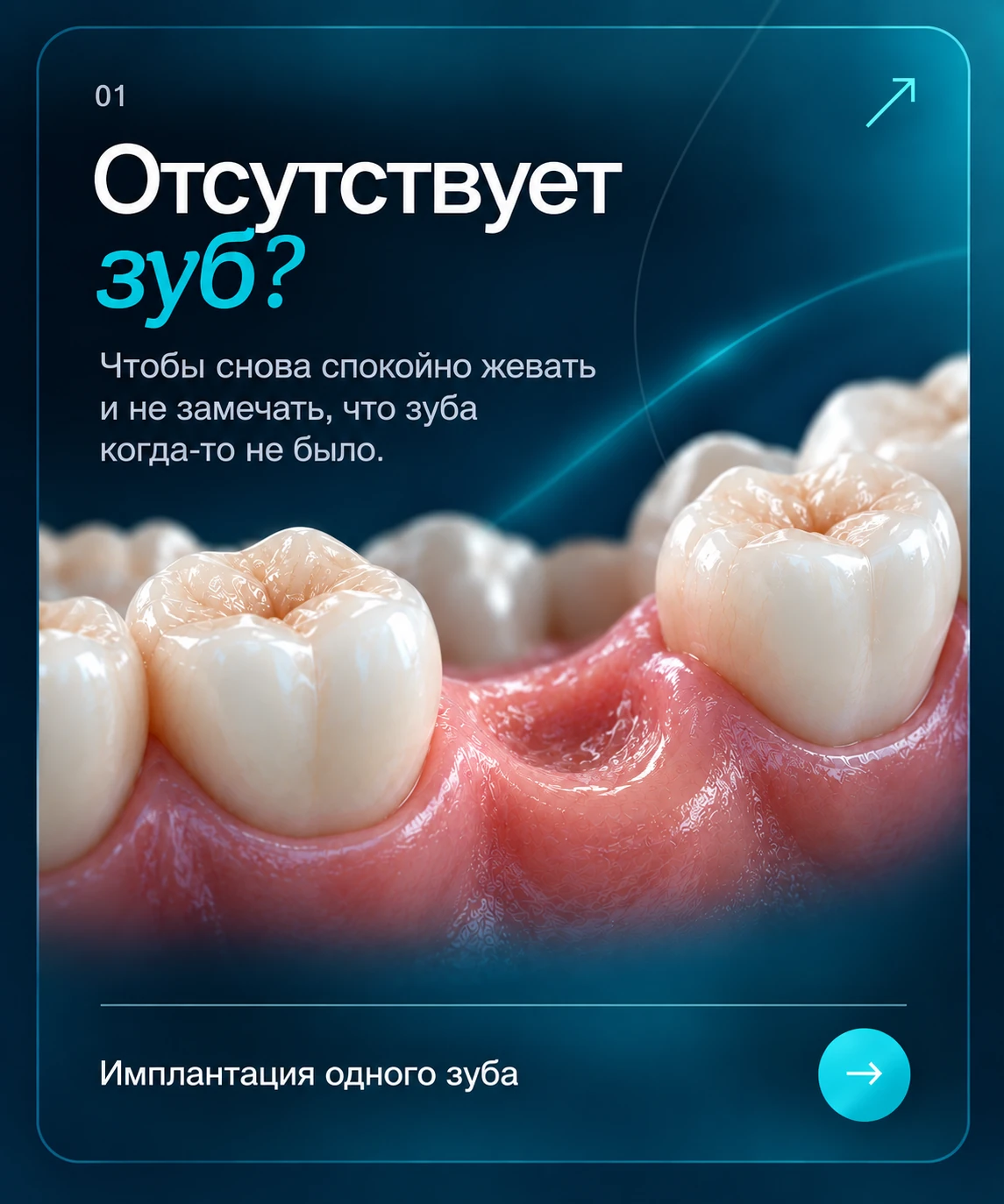 Отсутствует зуб? Имплантация одного зуба