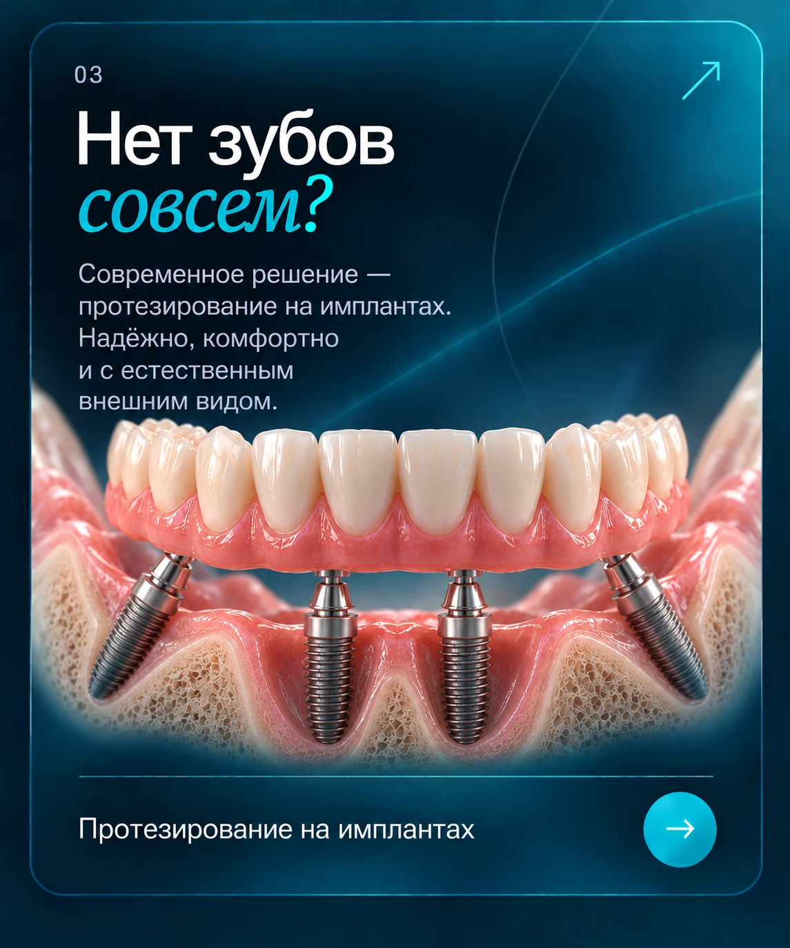 Нет зубов совсем? Протезирование на имплантах